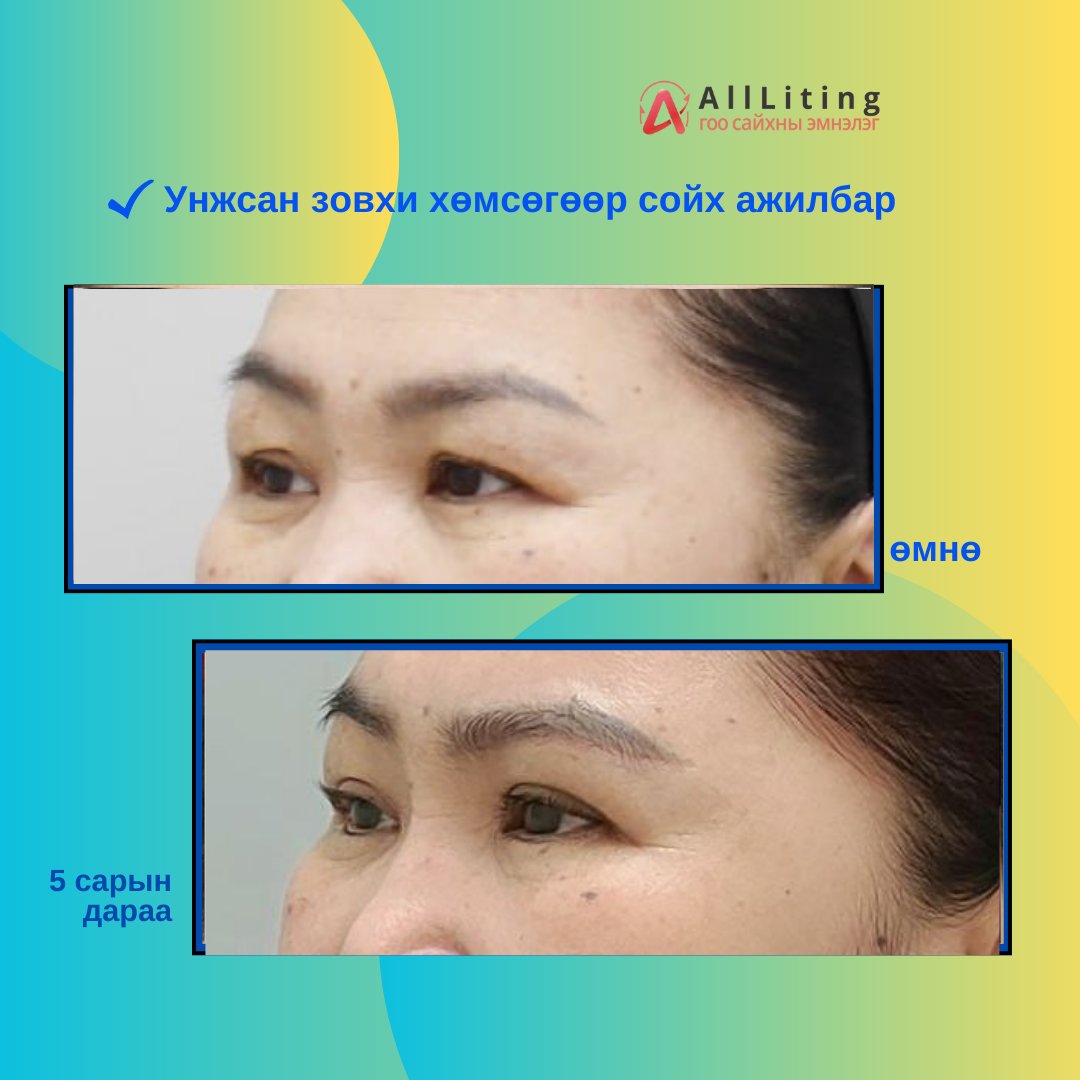 хийлгэсэн ажилбар
📷Унжсан зовхи хөмсөгөөр сойх ажилбар
-------------------------
📷📷 ҮЗЛЭГ/ЗӨВЛӨГӨӨ үнэгүй хийж зөвхөн таньд тохирсон мэс заслын төлөвлөгөөг гаргана.
📷монгол ажилтан: 010-4931-4451