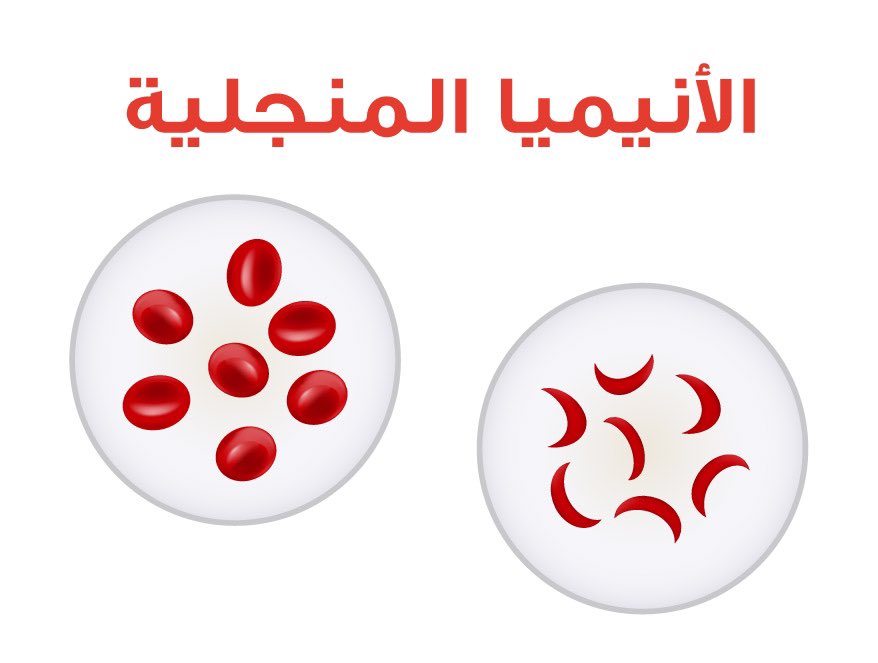 Imammc2023's tweet photo. بمناسبة #اليوم_العالمي_للأنيميا_المنجلية ..يسر إدارة الخدمات الطبية دعوتكم لزيارة الركن التوعوي المقام بالمجمع ينظمه قسم المختبر بإشراف سعادة الدكتور/مشاري العبداللطيف استشاري المختبرات الطبية وعضو هيئة التدريس بكلية الطب.
وذلك يوم الأحد الموافق ٢٣/ ٧ /٢٠٢٣،،من الساعة ٩-١٢ظهراً. https://t.co/OiH1Y5Epq1