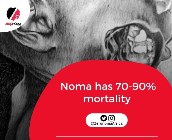 ZeronomaAfrica's tweet photo. A disease with this mortality rate truly deserves attention and adequate actions. 

We need to achieve #ZeroMortality. Much more, we need to achieve #Zerocases of Noma.

Won't you rather join us??

@SoceFallBirima @ToyinSaraki @aproko_doctor @IFDerm
@CombatNTDs @yangaza209 https://t.co/ndhdxEIZ5O