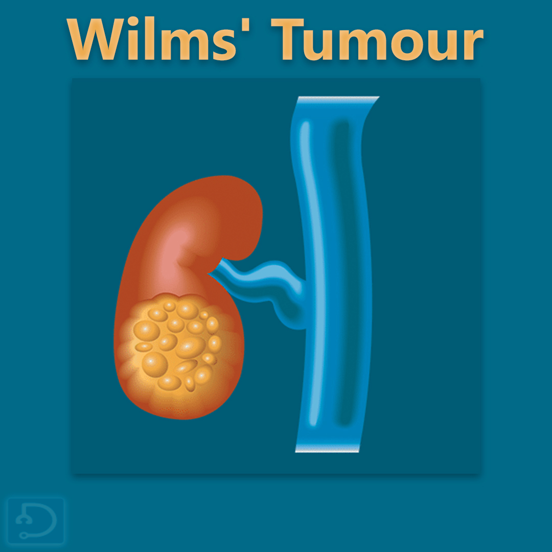 Wilms tumor is the most common kidney cancer in children. It usually affects kids between 3 to 4 years old.

Click here 🔗bit.ly/44pbFgR to learn more 🔖📚

#WilmsTumor #ChildhoodCancer #MedTwitter #Docsteth #KidneyCancerAwareness #EarlyDetection #HealthEducation