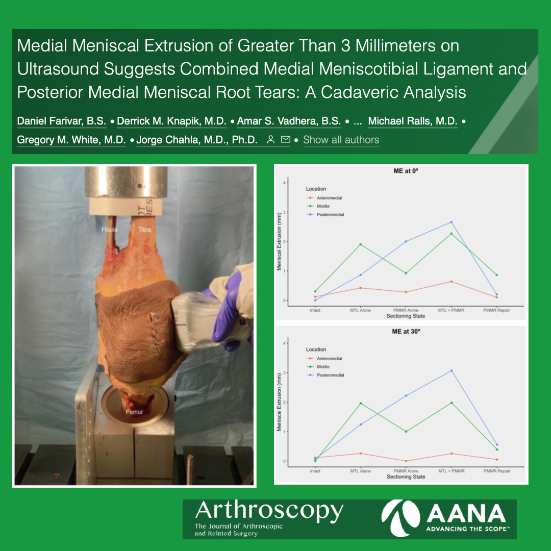 ArthroscopyJ's tweet photo. Overlooked meniscotibial ligament pathology may contribute to persistent meniscal extrusion following posterior medial meniscal root repair @jachahla https://t.co/r15iH6F4KJ https://t.co/4PK6m0WRdu