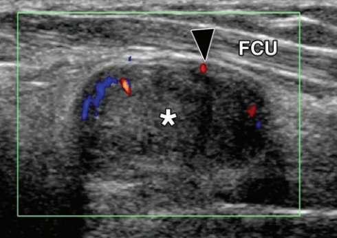 Rheumatology's tweet photo. 2 FREE PDF

Sonography of Masses of the Wrist and Hand
https://t.co/EAgw529HV6

and

Pitfalls in Wrist and Hand Ultrasound
https://t.co/7MaOqfF0OS https://t.co/wCbrBOKrmJ