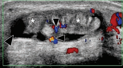 Rheumatology's tweet photo. 2 FREE PDF

Sonography of Masses of the Wrist and Hand
https://t.co/EAgw529HV6

and

Pitfalls in Wrist and Hand Ultrasound
https://t.co/7MaOqfF0OS https://t.co/wCbrBOKrmJ