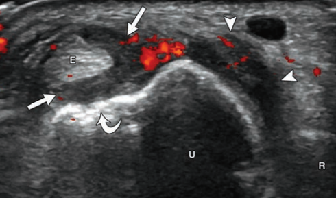 Rheumatology's tweet photo. 2 FREE PDF

Sonography of Masses of the Wrist and Hand
https://t.co/EAgw529HV6

and

Pitfalls in Wrist and Hand Ultrasound
https://t.co/7MaOqfF0OS https://t.co/wCbrBOKrmJ
