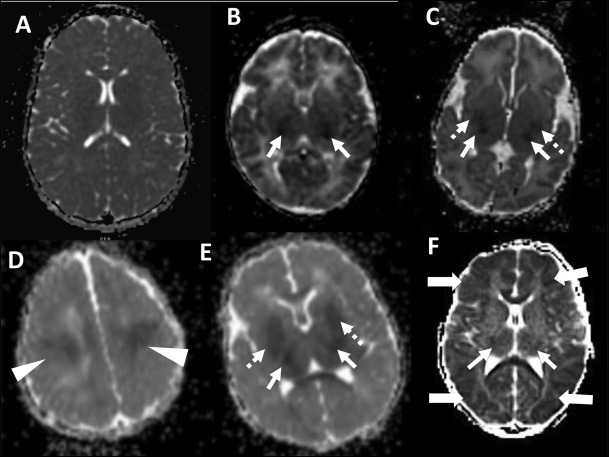 pedneurojournal (@pedneurojournal) on Twitter photo Did you know that MRI may predict cerebral palsy (CP) at 4⃣ years in neonatal encephalopathy (HIE)?
Risk of moderate to severe CP:
- Low (<20%) in all brain injury patterns except when the basal ganglia/thalamus MRI risk score = 4 📷67%
shorturl.at/mtOPW
<a href="/HCGlassMD/">Hannah C. Glass</a> Did you know that MRI may predict cerebral palsy (CP) at 4⃣ years in neonatal encephalopathy (HIE)?
Risk of moderate to severe CP:
- Low (<20%) in all brain injury patterns except when the basal ganglia/thalamus MRI risk score = 4 📷67%
shorturl.at/mtOPW
<a href="/HCGlassMD/">Hannah C. Glass</a>