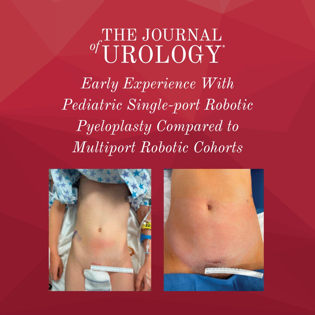 JUrology's tweet photo. Early Experience With Pediatric Single-port Robotic Pyeloplasty Compared to Multiport Robotic Cohorts

Click here to read ➡️ https://t.co/D5ODA9UFMT or click the link in our bio! https://t.co/Iq5zDtGujt