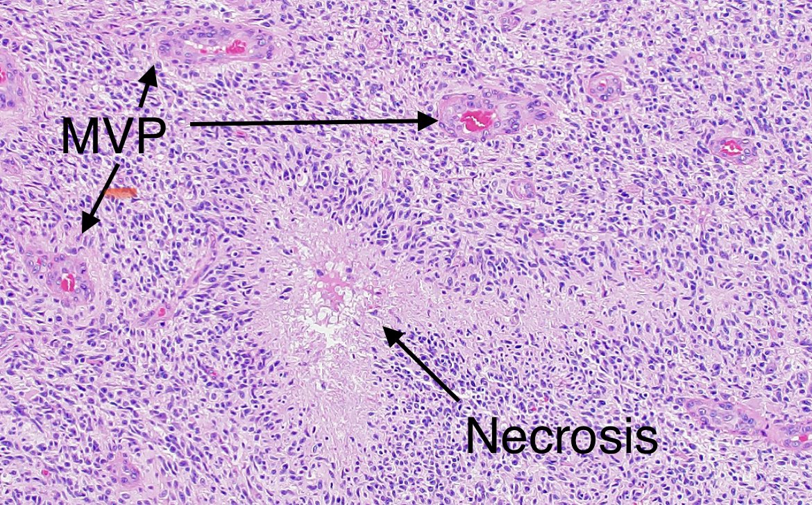 JaredAhrendsen's tweet photo. #GlioblastomaAwarenessDay

#Neuropathologists look at tissue under a microscope to diagnose #GBM so that patients can receive appropriate treatment. Features we look for include pseudopalisading necrosis and microvascular proliferation. https://t.co/mW191Hse5I
