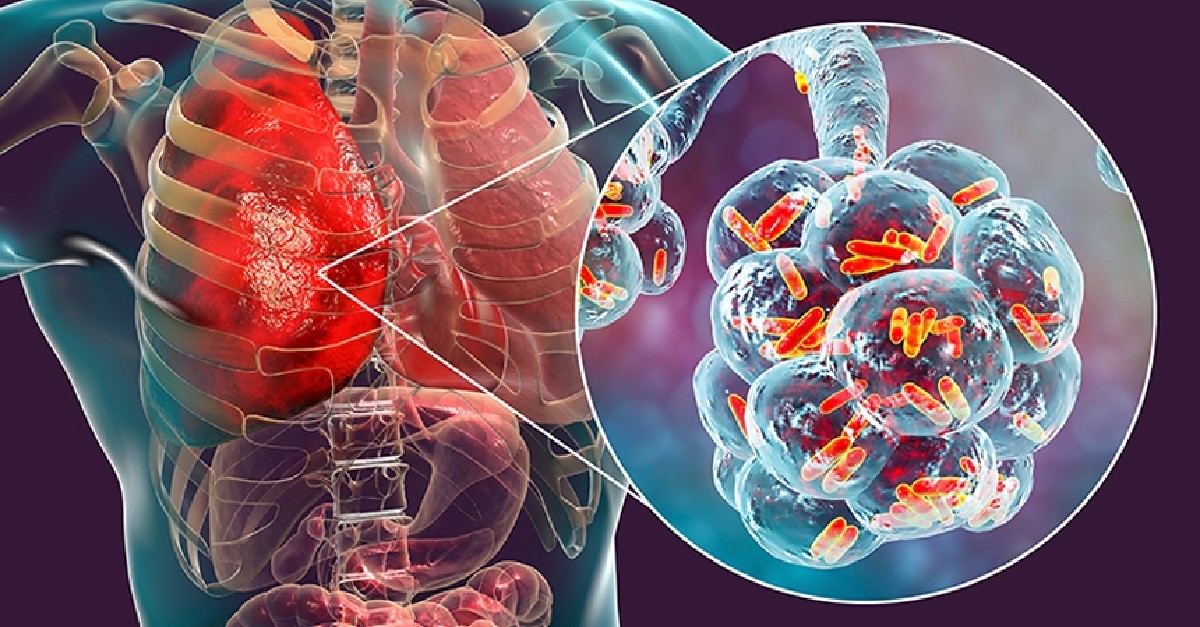 Comorbid respiratory diseases, including bronchiectasis, chronic obstructive pulmonary disease (COPD), and tuberculosis, are associated with an increased risk for nontuberculous mycobacterial pulmonary disease. Study in <a href="/journal_CHEST/">CHEST® Journal</a>. <a href="/van_jakko/">Jakko van Ingen</a> 

fal.cn/3A3dh