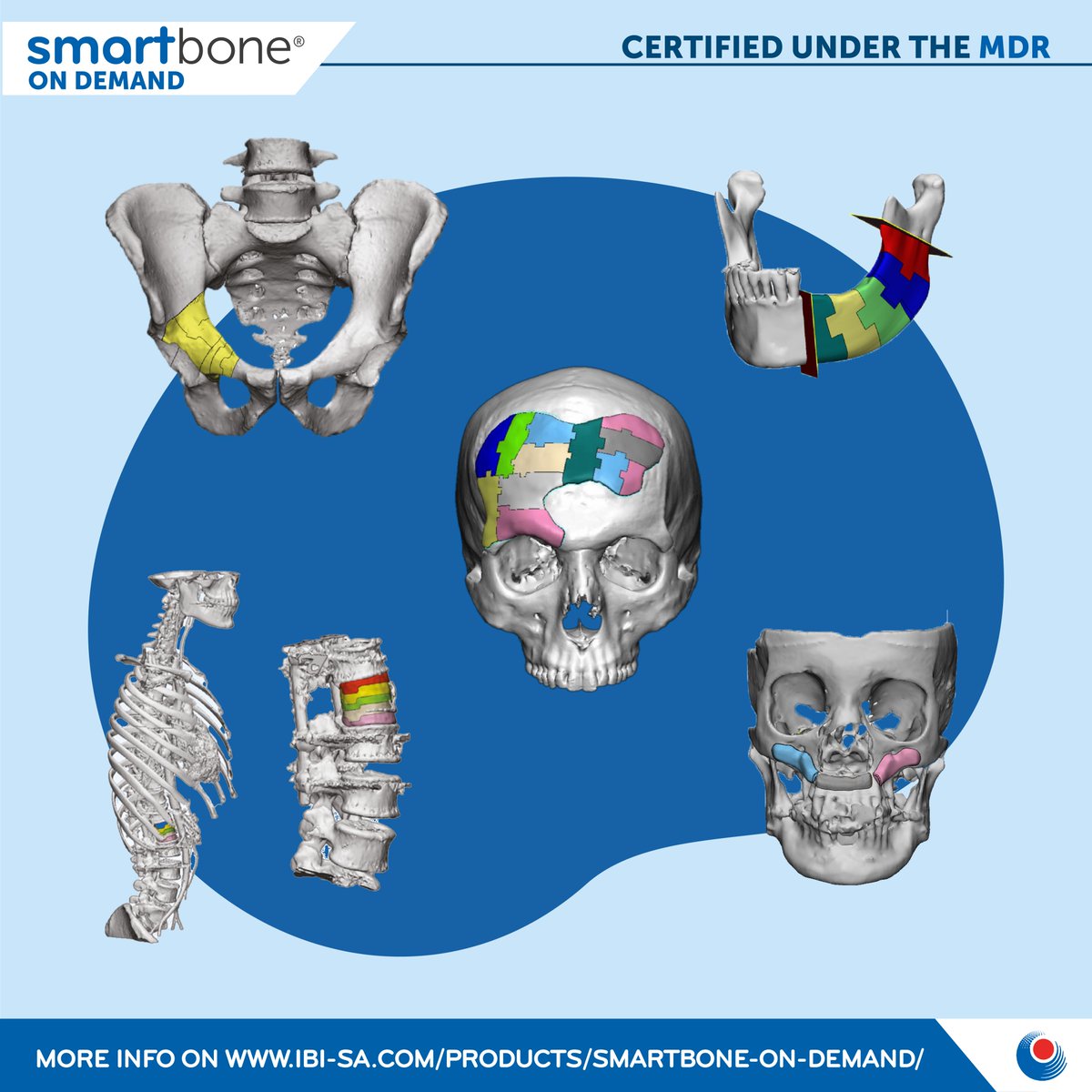 smartboneibi's tweet image. Thanks to the high performances, workability, resistance, and shape retention of #SmartBone®, we produce custom-made #bone grafts for YOUR specific reconstructive surgeries in #maxillofacial, #orthopedic, and #spinal fields.

Explore more: ibi-sa.com/products/smart…