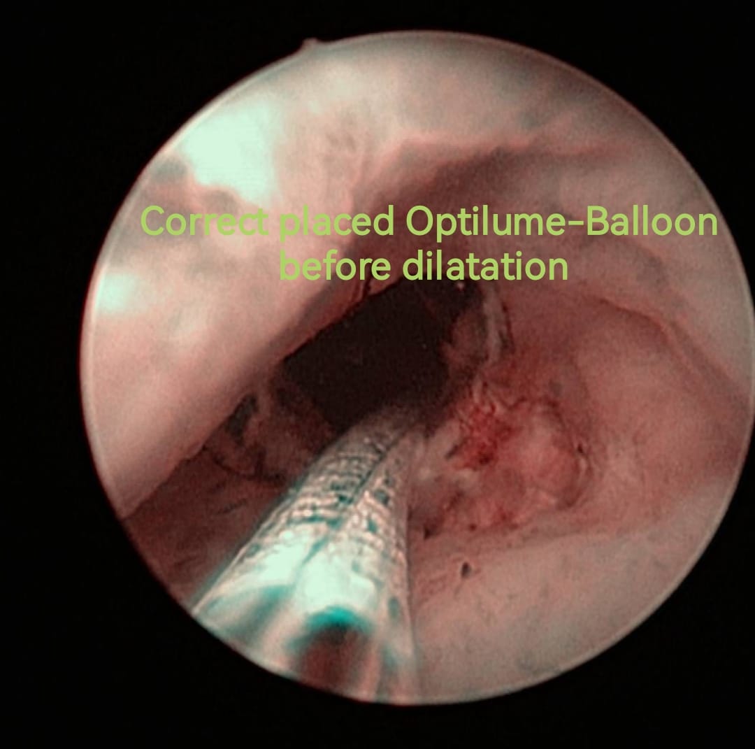 OTosev's tweet photo. #Optilume treatment of significant bladder neck stricture after resection of the prostate.
#Tosev https://t.co/1OP1qzPxpb