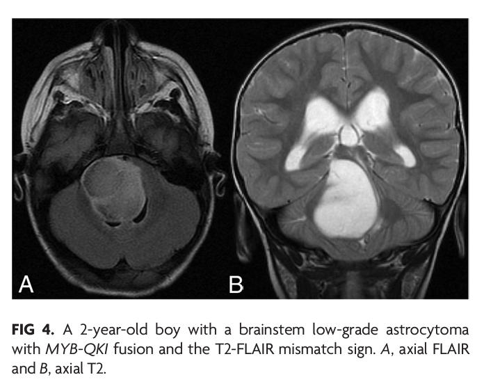 "T2-FLAIR Mismatch Sign in Pediatric Low-Grade Glioma" #Gliomas #FellowsJournalClub #OpenAccess <a href="/The_ASPNR/">American Society of Pediatric Neuroradiology</a> | bit.ly/3OwDMFz