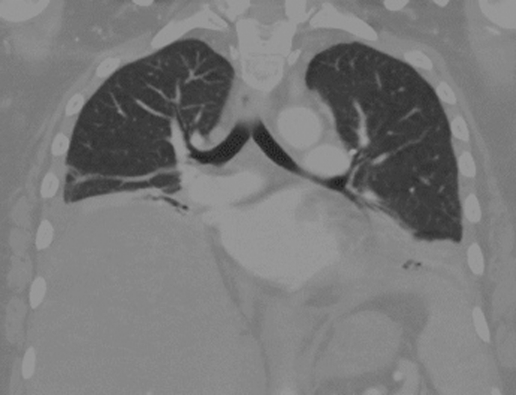 For #thoracicthursday, a young woman with Lupus has improved on prednisone but notes persistent dyspnea and some pleuritic discomfort.   Restrictive PFTs, but DLCO OK.  CT negative for pulmonary embolism.  No PH on echo.  Sniff test normal. Thoughts on diagnosis or treatment?