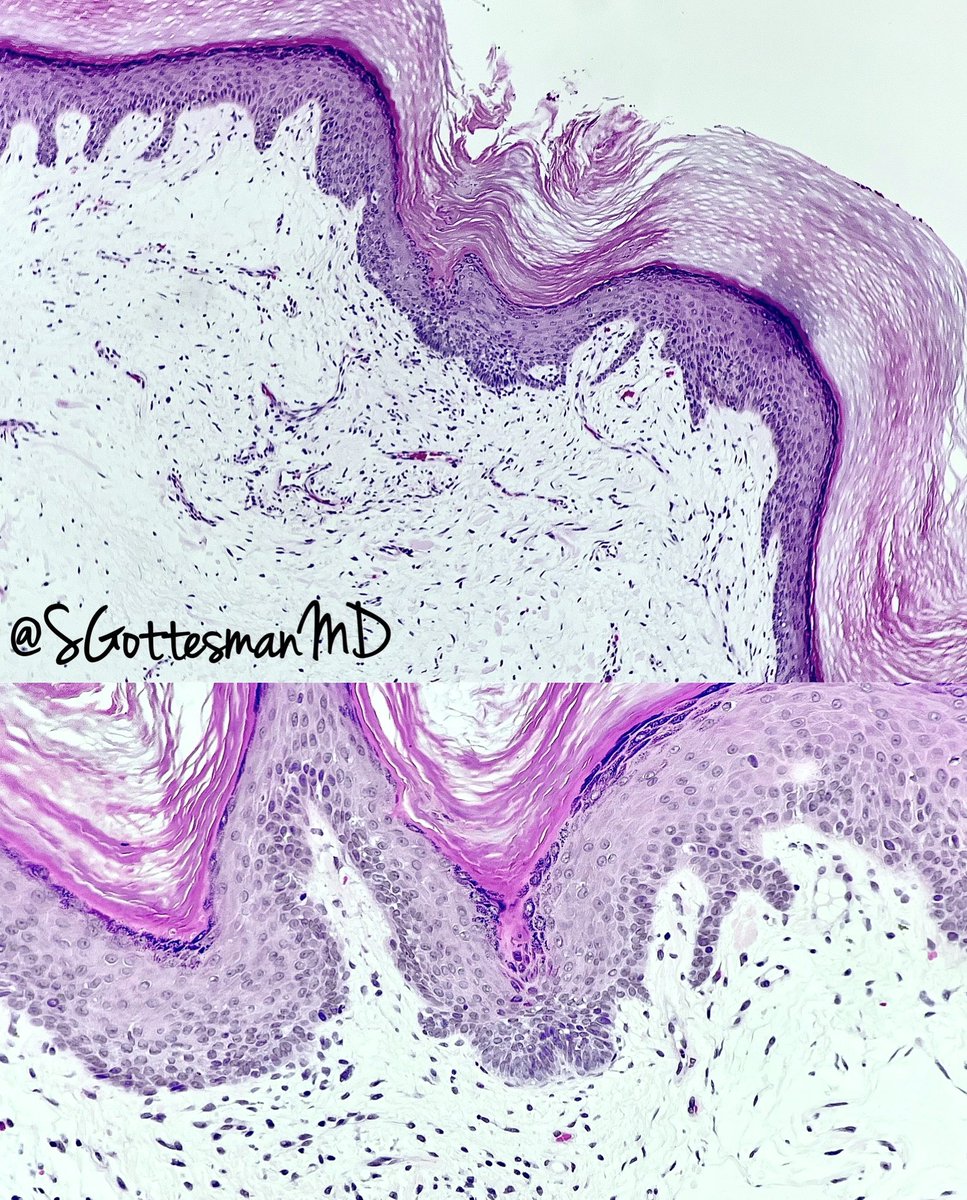 Let’s add focal cutaneous mucinosis to the list of things that can have basaloid follicular induction. #dermpath #dermatology #pathology #RealLifeDermpath Further reading: PMID: 19542921 and 29293479, both in the @IntSocDermpath journal.