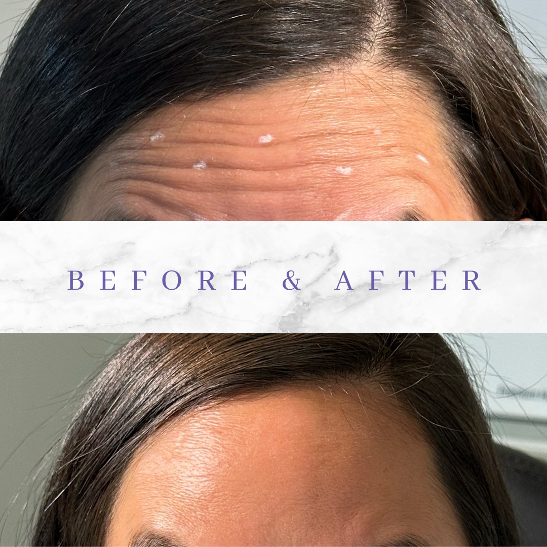 narsabq's tweet photo. Transformation Thursday, Woohoo! 🎉Say goodbye to #wrinkles and hello to smooth, radiant skin! 🤩
📲 Book with us Today, 505.554.4291
PROMOTION 🌟: $8/units of NewTox through end of #July !!

 #AntiAging #WrinkleFree #SmoothSkin  💆‍♀️ #narsaesthetics #skin #albuquerque #dyspo... https://t.co/nC3lLIRBxc