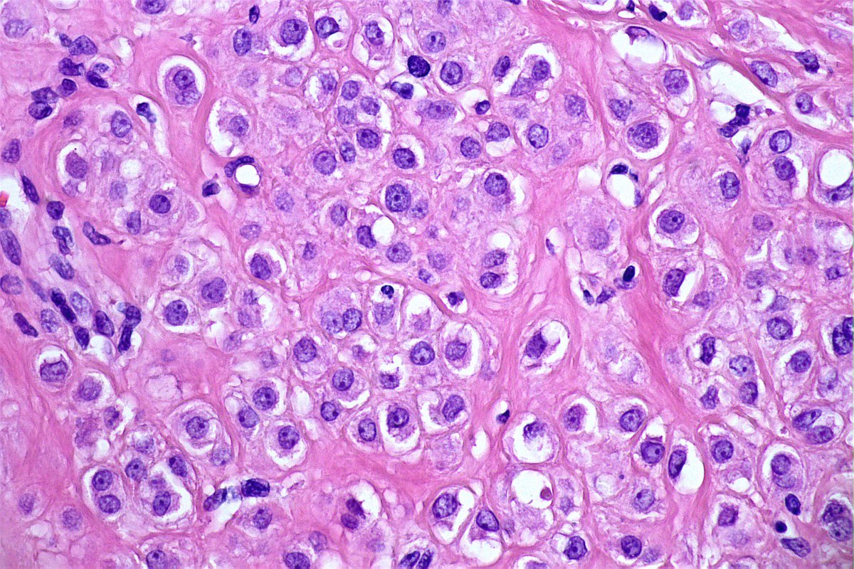 GeronimoJrLapac's tweet photo. Help, please. 30yo, Nodular lesion in frontal region.
s100, sox10,Melan A, cd34, desm, cd34 = neg
CD10+
#dermpath #pathlogy https://t.co/U9IaRRSLtP