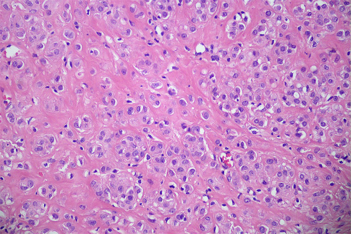 GeronimoJrLapac's tweet photo. Help, please. 30yo, Nodular lesion in frontal region.
s100, sox10,Melan A, cd34, desm, cd34 = neg
CD10+
#dermpath #pathlogy https://t.co/U9IaRRSLtP