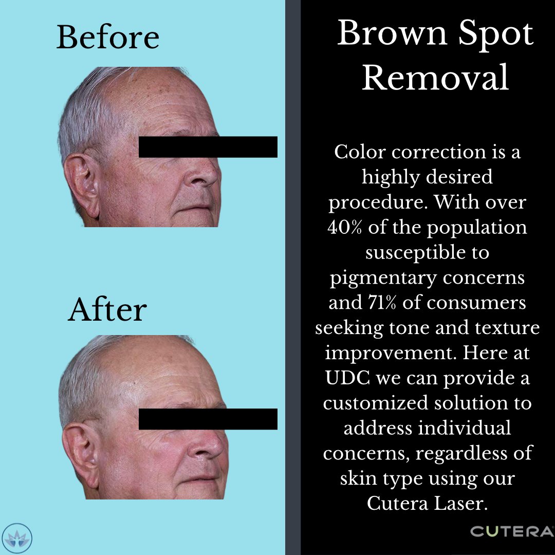 UDCDerm2017's tweet photo. Check out this great before & after of Brown Spot Removal! This service is preformed in our med spa by our aestheticians using our Cutera Enlighten Laser!! See one of our aestheticians for a free consultation to see if this is the right treatment for you!
#Cutera #UDCMedSpa #IN https://t.co/IxKPl1XCJb