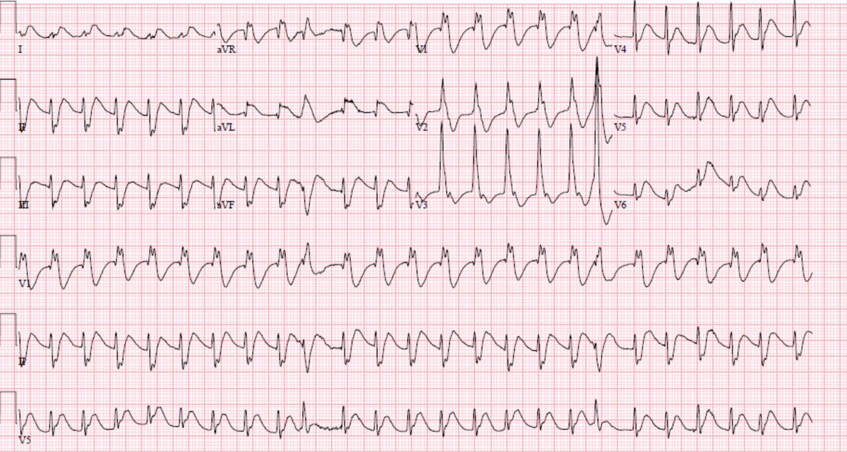 RJonesSonoEM's tweet photo. Throwback Thursday Sono Case (see thread). Mid-50s male witnessed collapse running into store. Initial rhythm: PEA to V.fib.ROSC in ED. 1st EKG. Culprit? #POCUS #FOAMcc #echofirst #FOAMed #MedEd #ECG @KalagaraHari @mount_md @smithECGBlog @PendellM @EM_RESUS @ArgaizR @IM_Crit_ https://t.co/2YBM2yPmwB