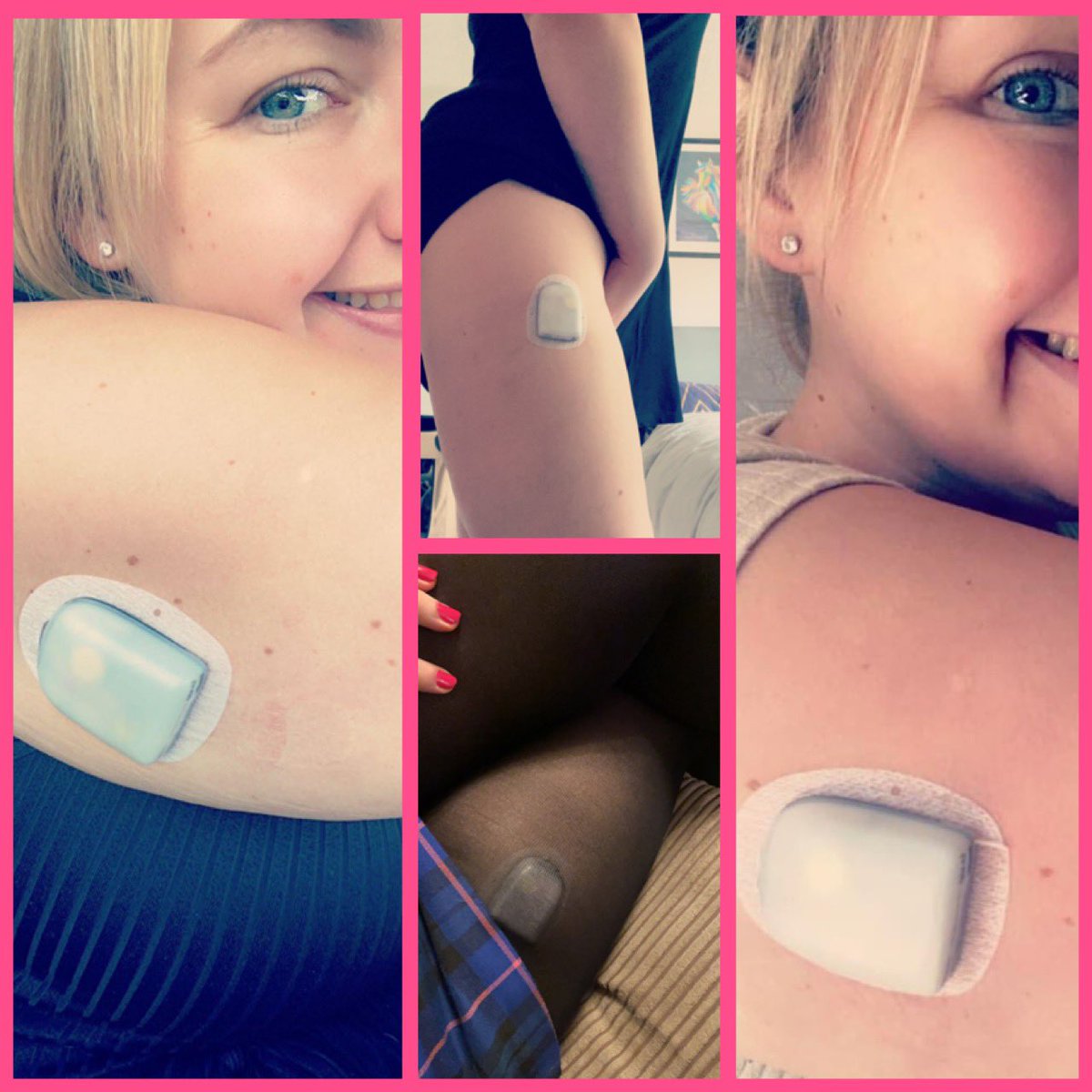 🔹One whole year living with an #insulinpump!
🔹One whole year of not having to inject #insulin at least 4 times a day!
🔹I have loved you 
🔹I have hated you
🔹You have been a conversation starter
🔹But most of all you have made my life easier! 
#type1diabetes #omnipoddash #T1D