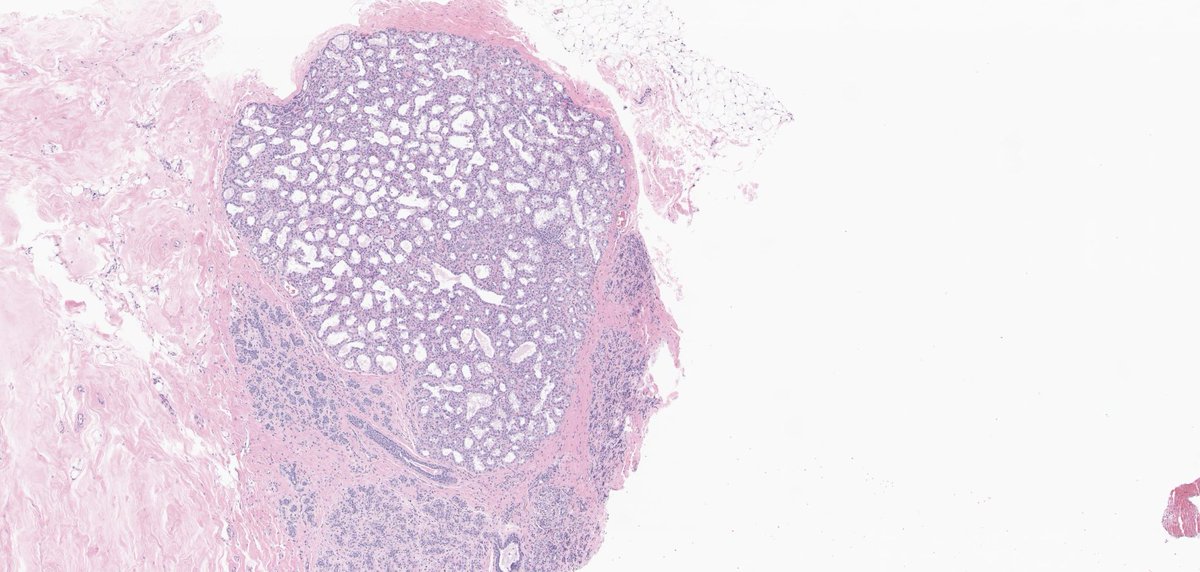 Lactational changes in the breast parenchyma
🔶Glandular cells are enlarged with abundant pale or clear, finely granular or vacuolated cytoplasm