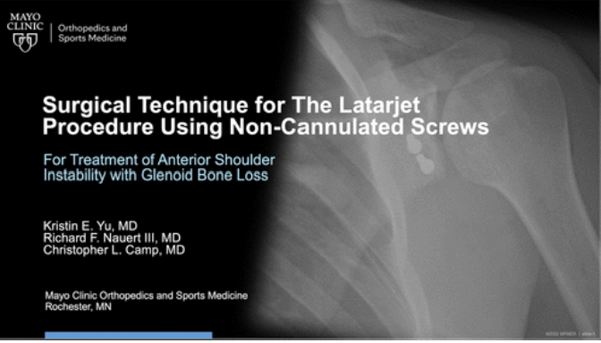 Video Journal of Sports Medicine (@videojsportsmed) on Twitter photo The Latarjet procedure is an effective option 4 anterior glenohumeral instability & may be enhanced with solid screws, proper anatomic technique & capsulolabral repair augmentation.
<a href="/mayoclinicsport/">Mayo Clinic Orthopedics and Sports Medicine</a> <a href="/ChrisCampMD/">Christopher Camp, MD</a> <a href="/KristinYu7/">Kristin Yu, MD</a> <a href="/MayoOrthoRes/">Mayo Orthopedic Residency</a>
Watch: ow.ly/cR7u50Pa4cK The Latarjet procedure is an effective option 4 anterior glenohumeral instability & may be enhanced with solid screws, proper anatomic technique & capsulolabral repair augmentation.
<a href="/mayoclinicsport/">Mayo Clinic Orthopedics and Sports Medicine</a> <a href="/ChrisCampMD/">Christopher Camp, MD</a> <a href="/KristinYu7/">Kristin Yu, MD</a> <a href="/MayoOrthoRes/">Mayo Orthopedic Residency</a>
Watch: ow.ly/cR7u50Pa4cK