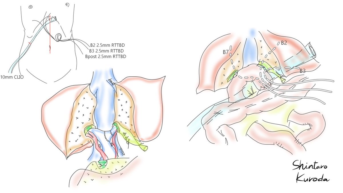 In Japan, drawing illustrations before and after surgery is considered a part of daily training.
Inputs and outputs of information improve understanding of anatomy and surgical proceedings.
Example: Central bisegmentectomy for perihilar cholangiocarcinoma.