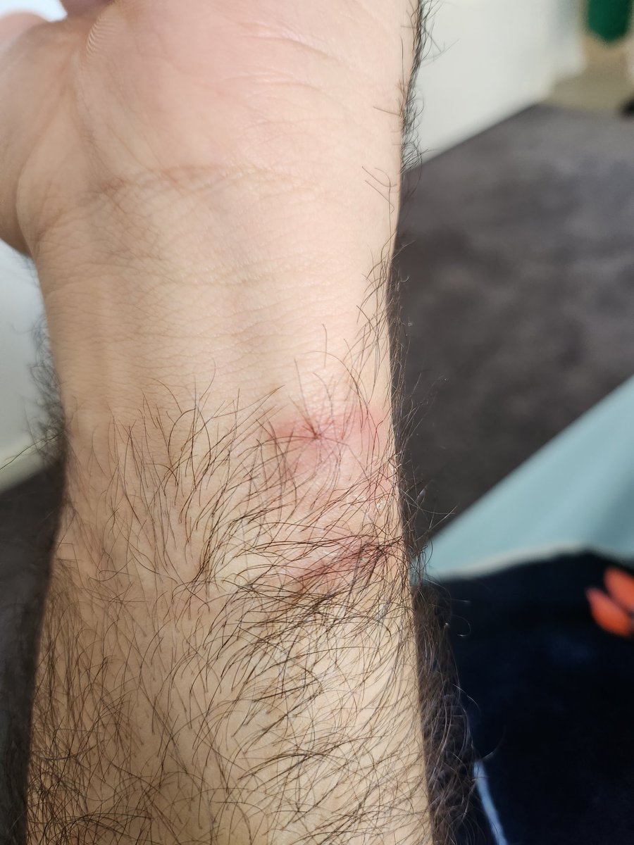 kingfeimer's tweet photo. @SamsungAU is this normal to get rashes after using #samsungwatch5 ?
Your service is of no use as they don't know what to do.
Apparently I also checked there is a lawsuit filled in US for this . https://t.co/4d5ED1AtXt