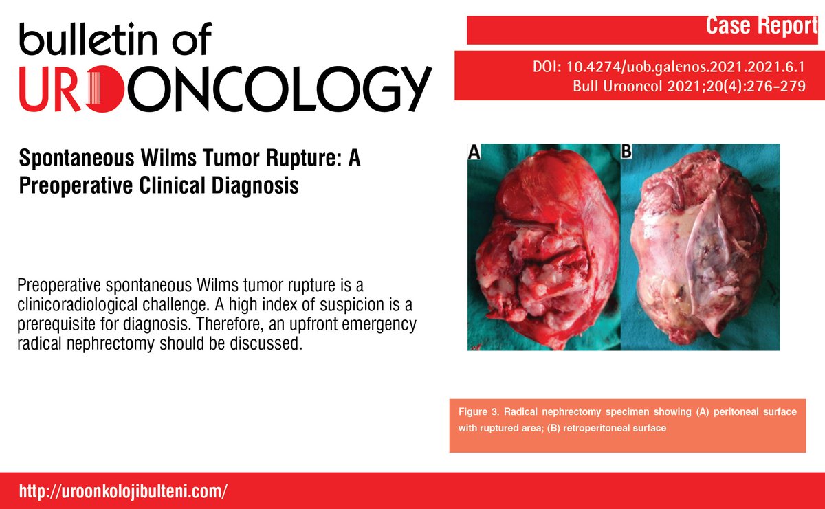 Spontaneous Wilms Tumor Rupture: A Preoperative Clinical Diagnosis

You can see the free full text of the research by et al.

Link : cms.uroonkolojibulteni.com/Uploads/Articl…

#Emergency #preoperative #radicalnephrectomy #rupture #spontaneous #Wilmstumor