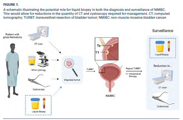 Great resource to learn about #ctDNA in GU cancers. Fantastic for an afternoon read this weekend. Thanks <a href="/pcvblack/">Peter Black</a> <a href="/SpiessPhilippe/">Philippe spiess</a> for the opportunity to help put together this issue of <a href="/SIU_Journal/">Société Internationale d'Urologie Journal</a> 
bit.ly/3kfexdV