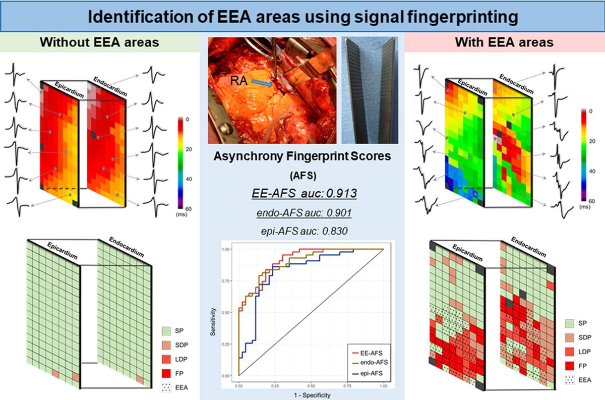 Endo-Epicardial #Electrogram asynchrony features as as a tool to identify #AtrialFibrillation substrates during SR: The Asynchrony Fingerprint Score Online available: bit.ly/HJC_AFS @HCSgr @hjc_ed @mathijsvschie @nmsdegroot #Epeeps #AFib #CardioTwitter #AFprediction