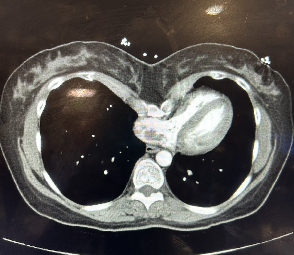 Severe Pectus Excavatum compressing against the right ventricle in the shape of #Infinity ♾️ #CardioTwitter