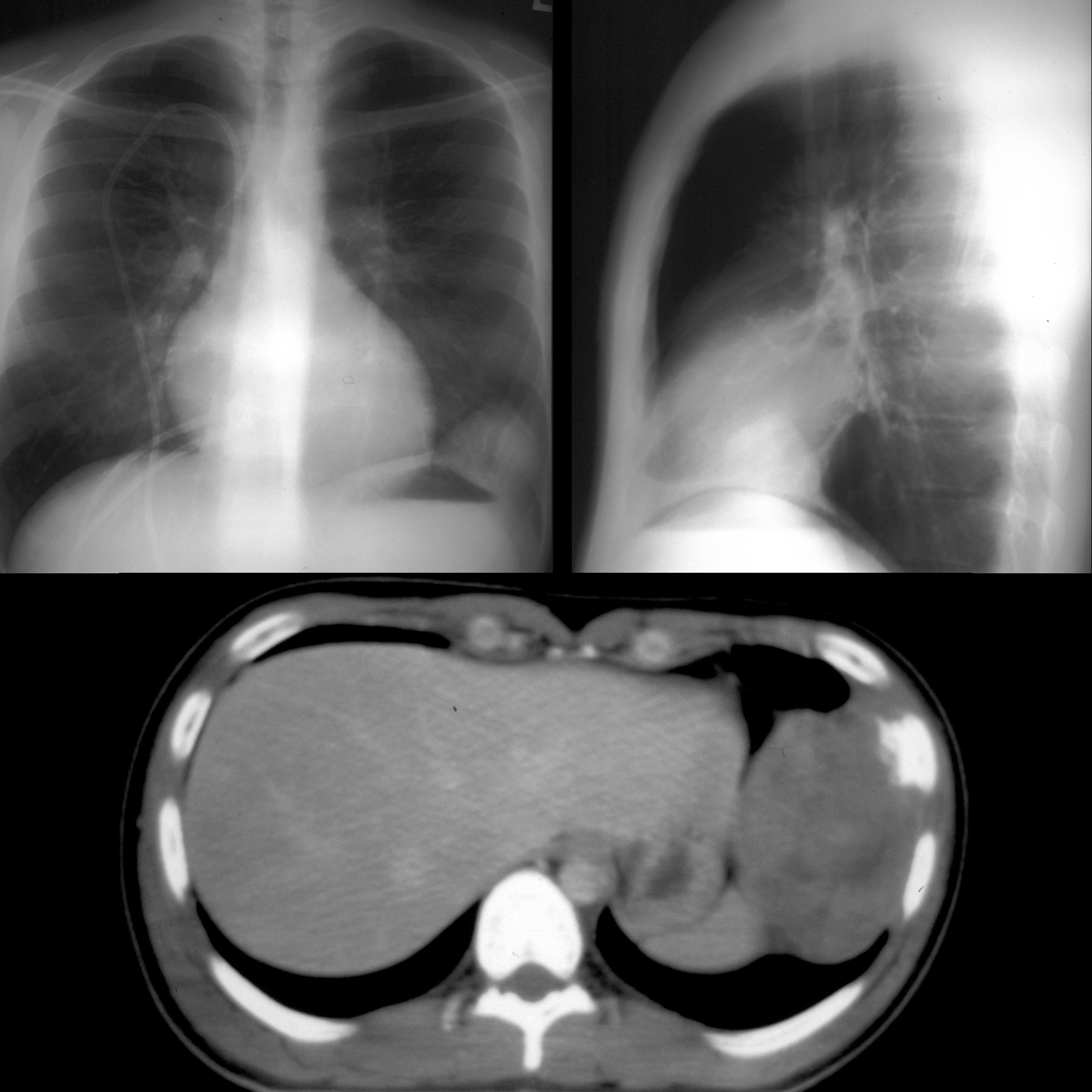 Pediatric Imaging on Twitter "Teen with fever+left pleuritic chest