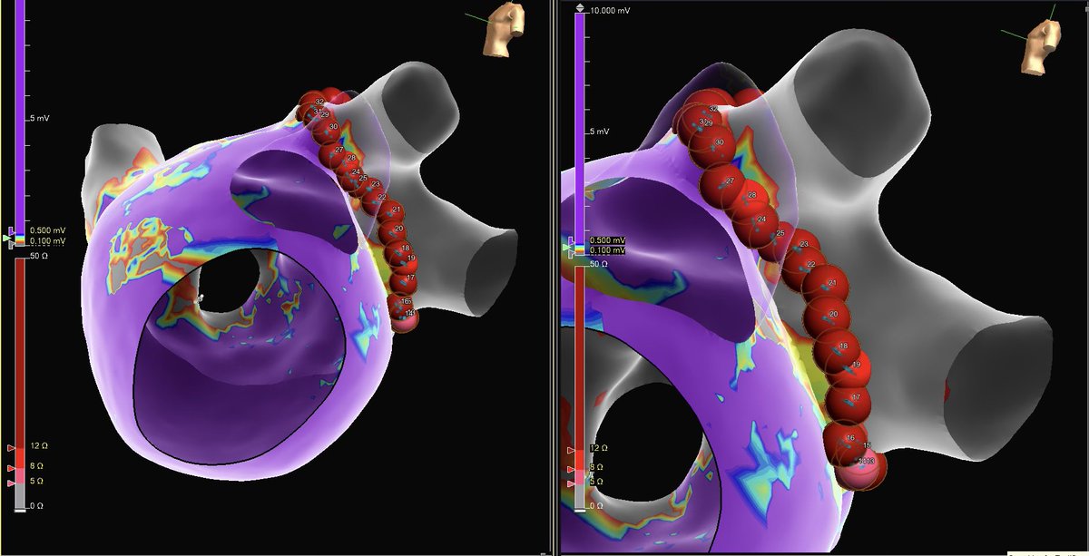 Amazing stability with #TactiFlex shown here with Autotrack, where #EnsiteX assesses the movement of the catheter during ablation. 

Dr. Glenn Dym at AdventHealth Celebration ablated the ridge and veins seamlessly with first pass isolation as the result. #AbbottProud