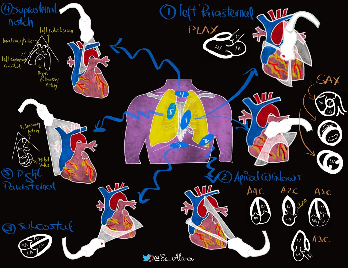 Some helpful cardiac #POCUS infographics 🫀Markers of RV strain by @rutgerspocUs & @SAlerhand from @RutgersEM 🪟 Obtaining various windows & views by @Ed_Alania 🌊Cardiac VTI by @Pocus101 #FOAMed #FOAMus @pocusmeded @POCUS_Society @Jailyn_Avi @coreultrasound @Wilkinsonjonny