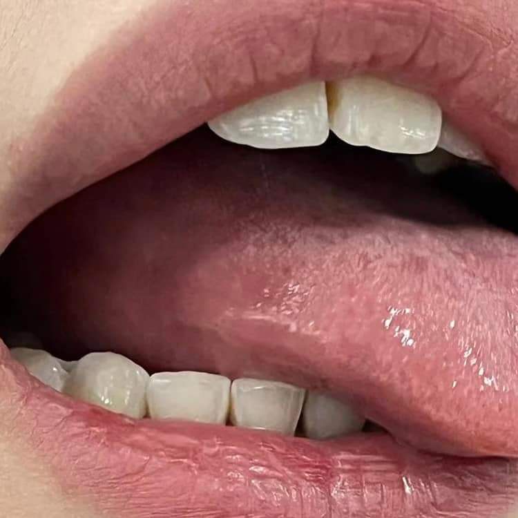 Siapa yang pernah kena saja tahu rasa seksa ulser tu macam mana betol tak? 

If sakit Ulser memang pakai Ulser patch ni. Sebab korg try  dengan garam memang pedih la cerita nya 😅😅

Boleh rasa kesan selepas guna dalam tempoh 1 ke 2 jam.