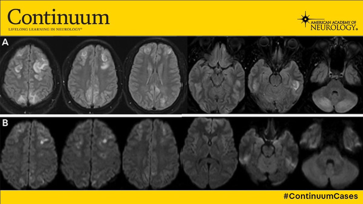 A 22 year old G1P1 woman develops headache and confusion 1 week after an uneventful delivery. En route to the ED she has a generalized seizure. On exam she is somnolent. BP 200/99 mmHg. MRI below (FLAIR⬆️ DWI⬇️). What’s your next step in this #ContinuumCase???🧵