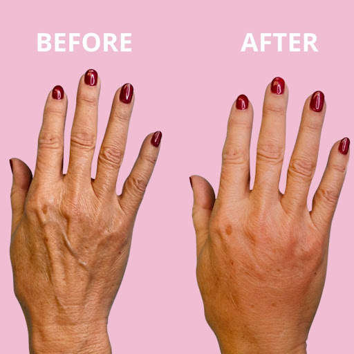MyRenuva's tweet photo. Unlock the secret to age-defying hands with #Renuva! 🔓💜

These beautiful Renuva results are courtesy of world-renowned, celebrity cosmetic dermatologist, Anna Guanche, MD, founder of Bella Skin Institute.

#MyRenuva

📷 @annaguanchemd &amp; @bellaskininstitute https://t.co/SvDqzjLWWa