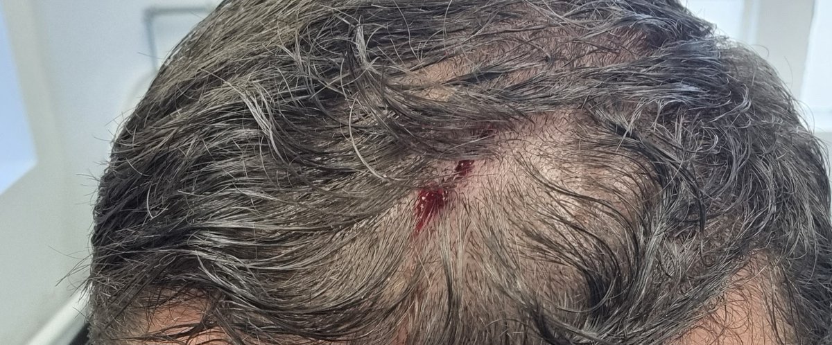 pbSef's tweet photo. Note to self: Before heading the football, remember, if you have sunglasses on your head ....take them off. 🥴 #heads #lifelessons #football https://t.co/pk4LUDsU7g