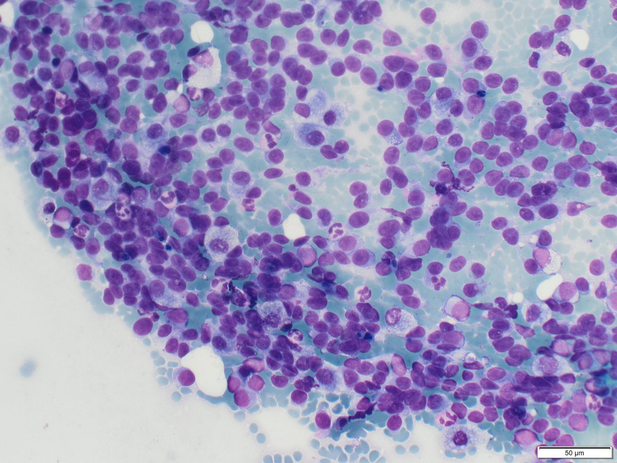 FNA of a lung mass in a older man with no known medical history for this #FNAFriday: