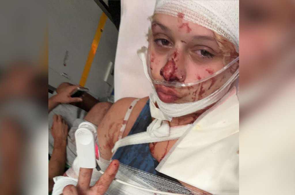 Wappie12345's tweet photo. Een vrouw zal waarschijnlijk de rest van haar leven misvormd blijven! De 19-jarige Nissan was op reis in #toulouse, #Frankrijk, toen ze werd aangevallen door 4 N-Afrikanen van 14, 15 en 17 jaar. Omdat haar topje te kort was, sneden staken ze haar 50x.
https://t.co/zJvCBoYd1S https://t.co/pBEaEeCr45