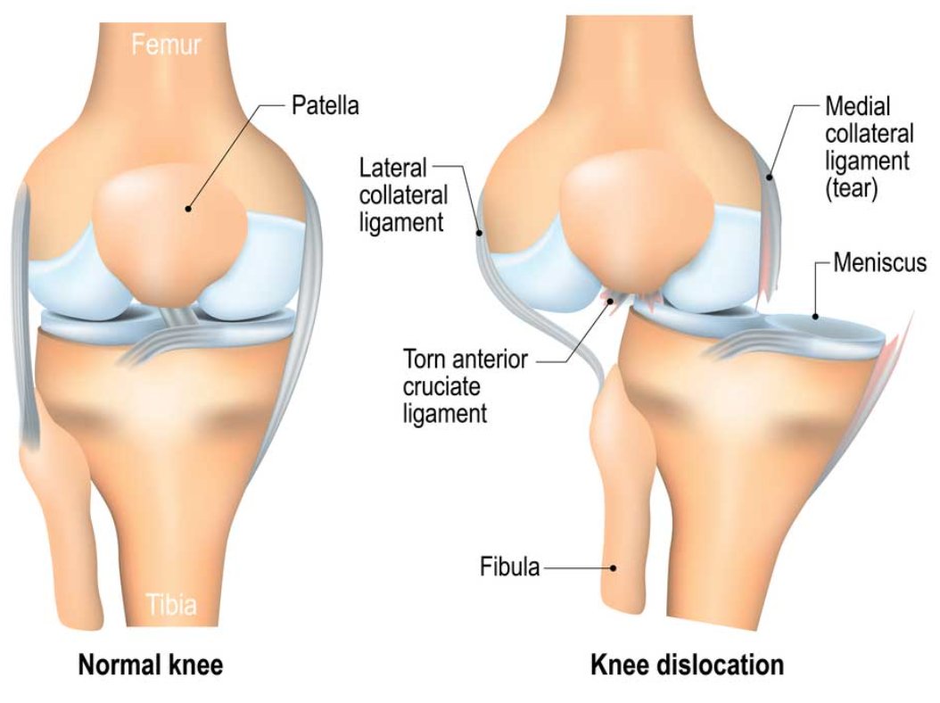 rileywilliamsMD's tweet photo. Knee Fact of the Day!
Less than 0.5% of all joint dislocations are #knee dislocations, making them a much less common injury. There are a number of factors that increase the risk of a #kneedislocation injury, including: https://t.co/HQ1PLjBMWF #orthotwitter https://t.co/wj9Vbx8wkV