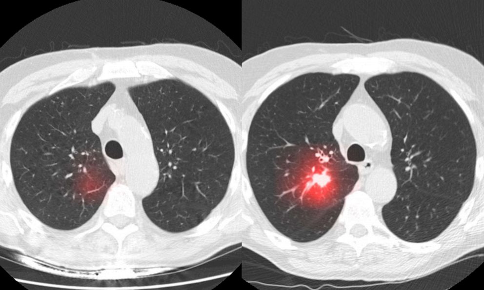 AdeAdamson's tweet photo. How AI is used to detect, treat cancer -- and the potential risks for patients https://t.co/F3N8RFvtdB glad this article provides some balance; however, I can't let the suggestion that we screen everyone for lung cancer like we do for colon cancer go unchallenged 🧵 https://t.co/hwTSr9MoZt