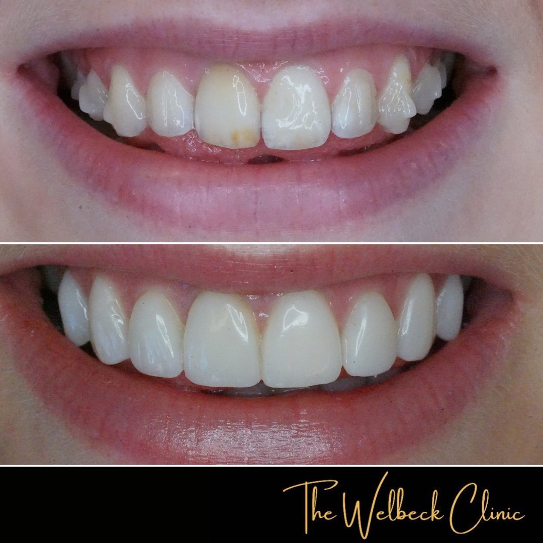 A closer look at this smile makeover @doctorjahany recently completed, you can see the results from using invisalign and then composite bonding to achieve this smile.
.
To book a consultation contact us on 0207 486 8100
.
#Smile  #invisalign #dentistry #compositebonding