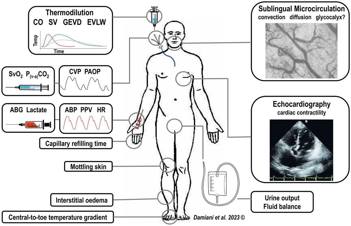 Microcirculation-guided resuscitation in sepsis: the next frontier? 

CCR Journal Watch
criticalcarereviews.com/latest-evidenc…

Get the latest critical care literature every weekend via the CCR Newsletter - subscribe at criticalcarereviews.com/newsletters/su…