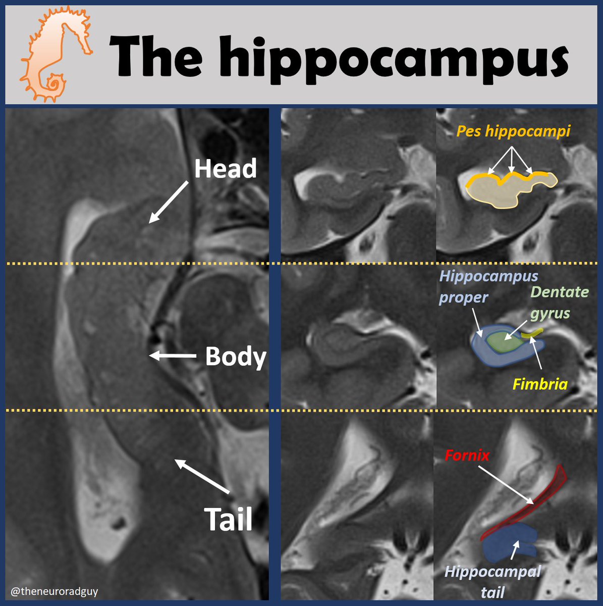 theneuroradguy's tweet photo. Radiological anatomy of the hippocampus; a short webinar on one of my favorite anatomical subjects: https://t.co/ufmVNxIUoM 

#MedEd #RadEd #FOAMed #RAdEd #Radres #Neurorad https://t.co/ro3246wq3a