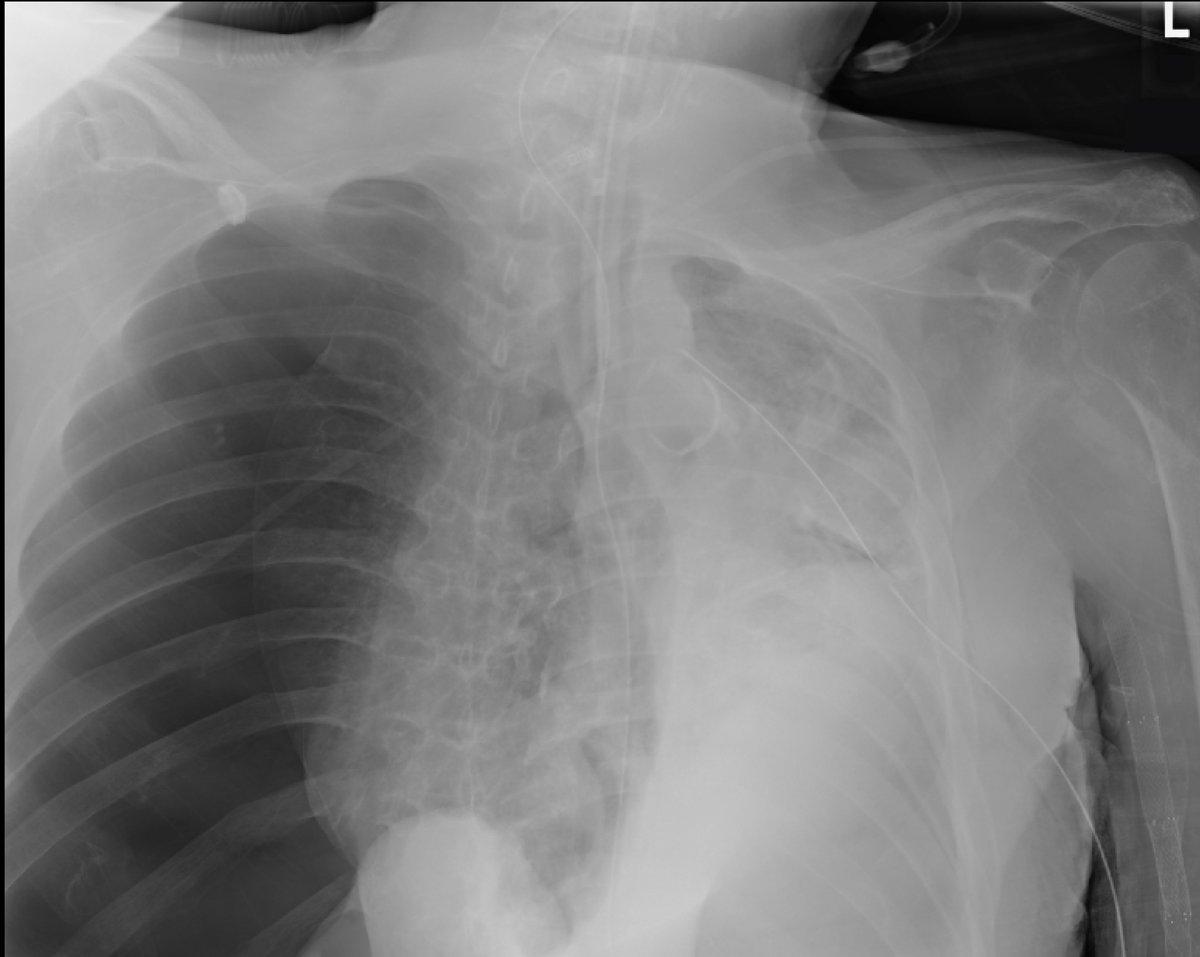This Chest X-Ray was sent to me with no clinical information

What’s the diagnosis?