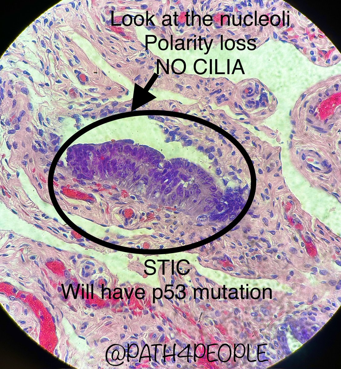 STIC 

Found in the fallopian tube and precursor to high grade tuboovarian serous carcinoma

Women who have #BRCA mutations are at high risk (that’s why their ovaries and fallopian tubes are prophylactically removed #angelinajolie)

#pathtwitter #gyntwitter #medtwitter @Path_SIG