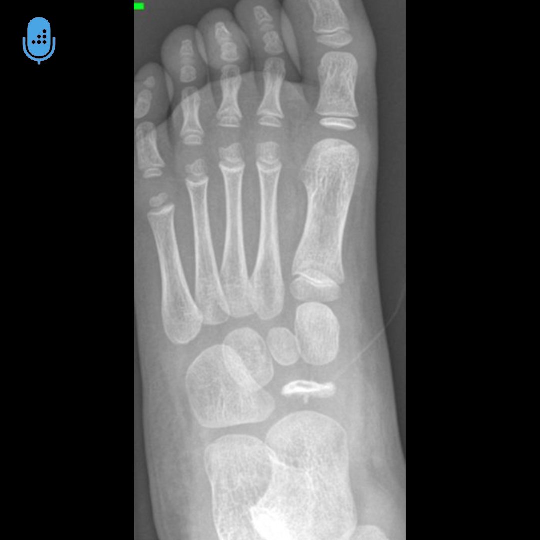 Orthobullets on Twitter "Kohler's Disease is a rare idiopathic