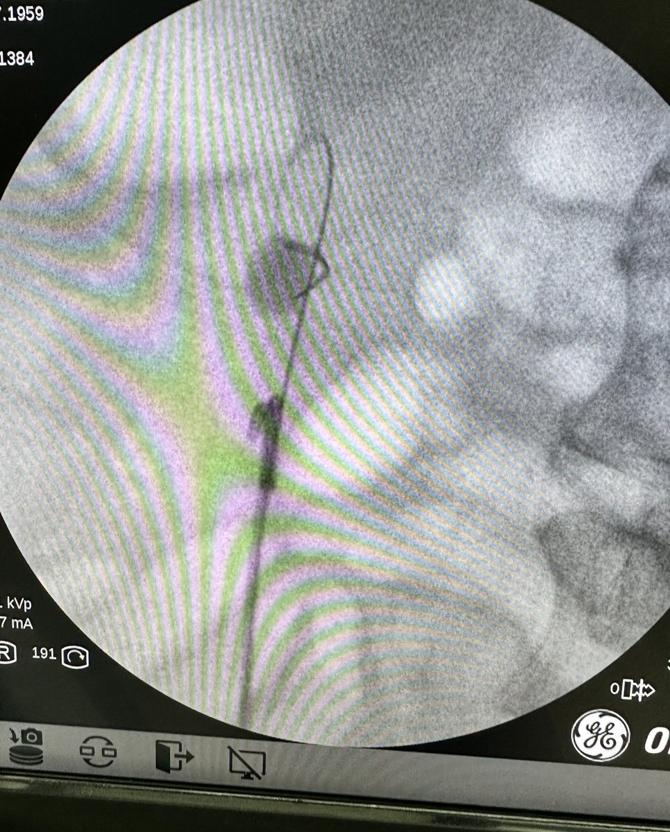 CHAIcaMD's tweet photo. When patient opted for RIRS instead of miniPCNL : 60 mins RIRS with Holmium laser on 1.5 cm PUJ stone. Would TFL be ideal? Can't wait to try bendable suction UAS too! Correct tools for the job is essential for better productivity. #Flexor #UroSoMe #Seplou @DocGauhar @D_Castellani https://t.co/lrCxUyihia