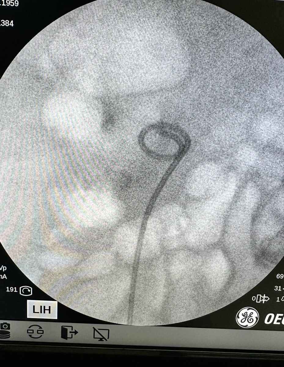 CHAIcaMD's tweet photo. When patient opted for RIRS instead of miniPCNL : 60 mins RIRS with Holmium laser on 1.5 cm PUJ stone. Would TFL be ideal? Can't wait to try bendable suction UAS too! Correct tools for the job is essential for better productivity. #Flexor #UroSoMe #Seplou @DocGauhar @D_Castellani https://t.co/lrCxUyihia